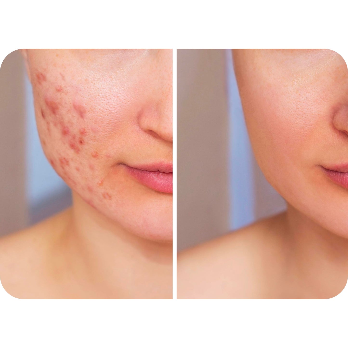 Hypochlorous Acid Spray 0.02% HOCl – Gentle Daily Cleanser for Face, Body & Eyelids, Safe for Acne-Prone, Red or Sensitive Skin, Non-Sting, 8 oz