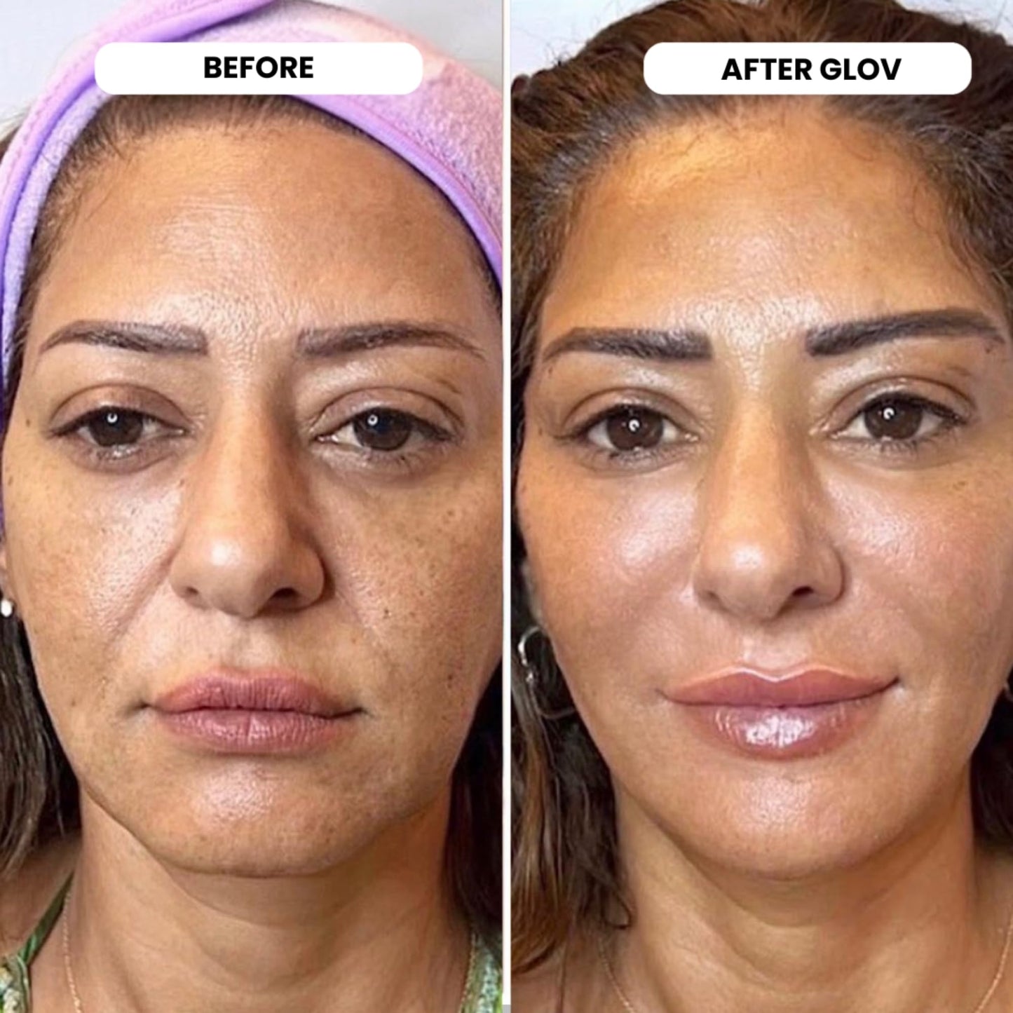 Glov Beauty Micro Infusion System – 0.25mm 24k Gold Facial & Lip Stamp with Hyaluronic Acid, Collagen & Licorice Root Serum Kit