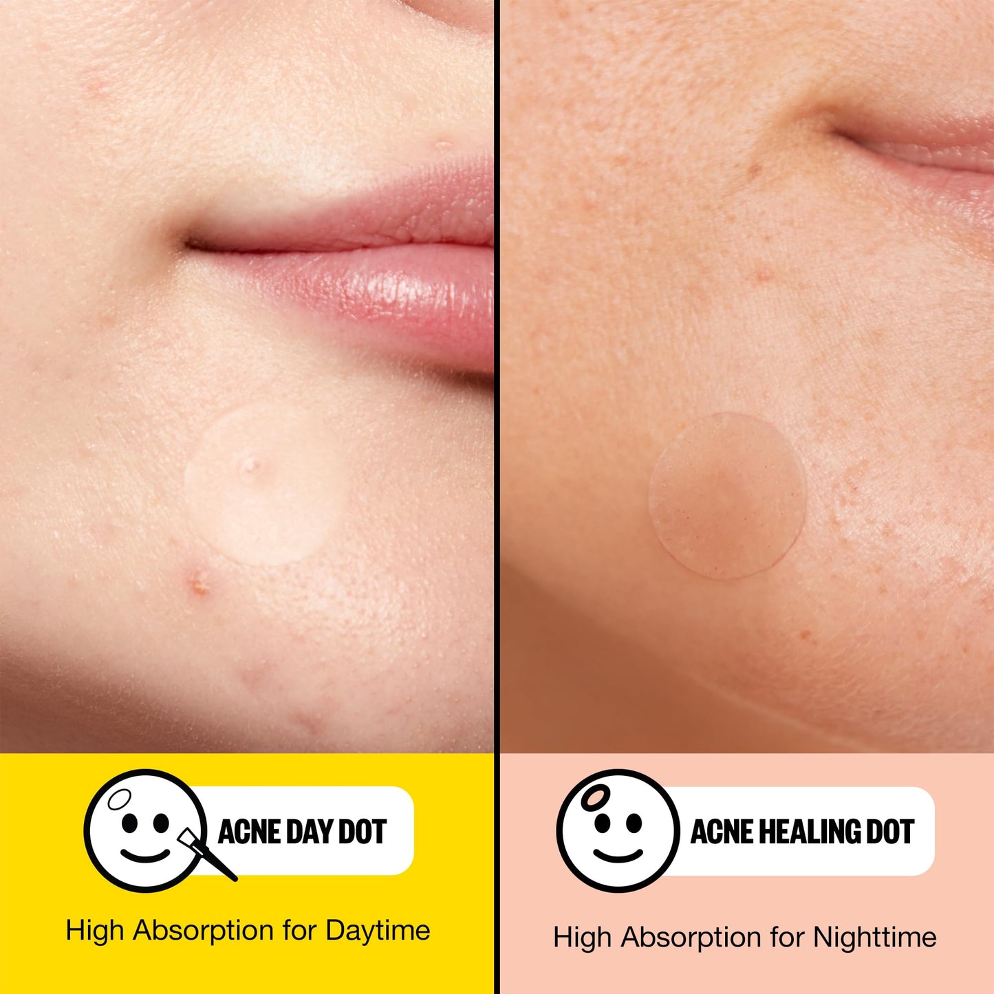 PEACE OUT Acne Day & Night Duo – Sheer Hydrocolloid Pimple Patches with Salicylic Acid, Retinol & Aloe Vera, 20 Dots for Fast Blemish Relief