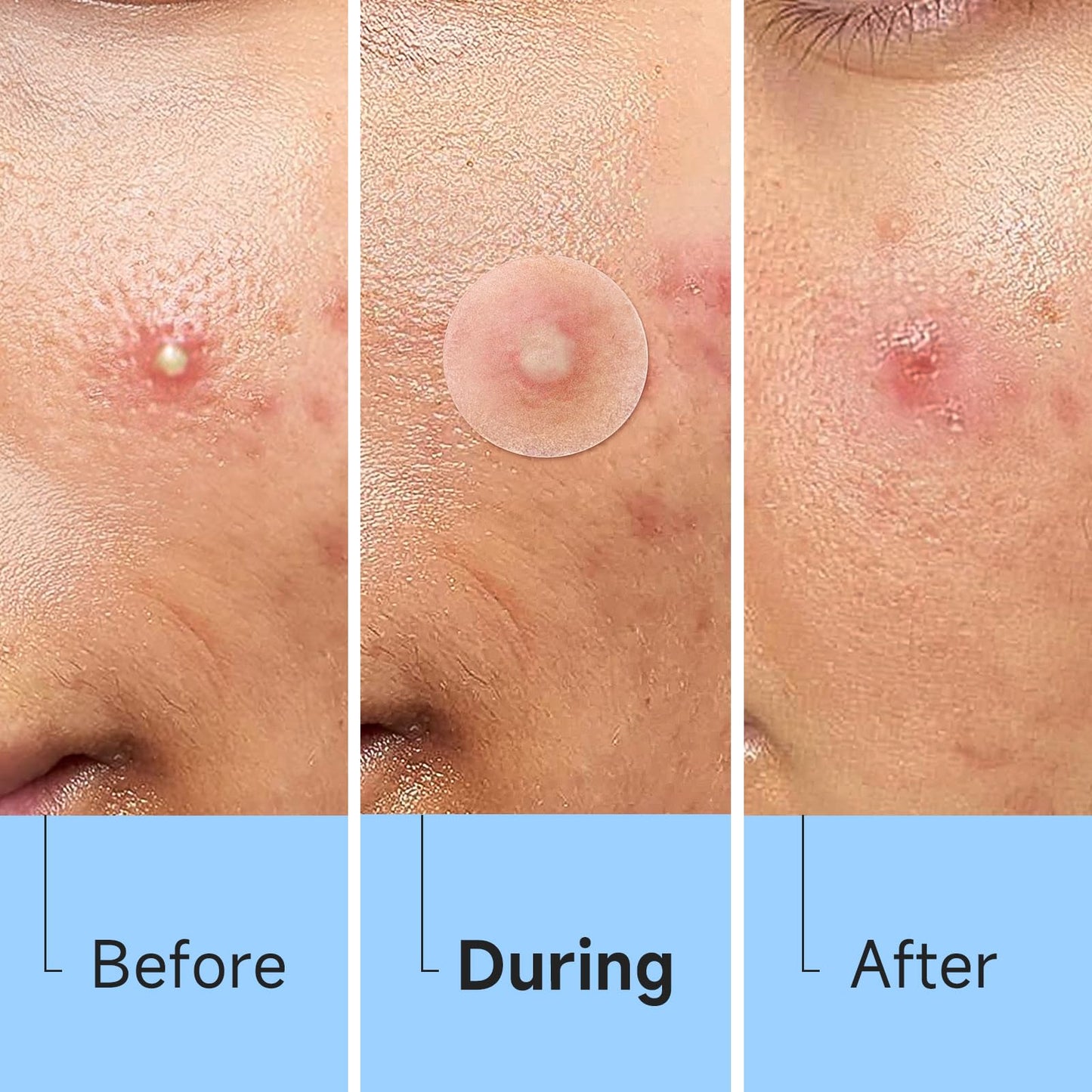 Glowpatch Pimple Patches for Face – 504 Hydrocolloid Acne Spots, 4 Sizes, Clear Zit & Blemish Stickers, FSA Eligible Bulk