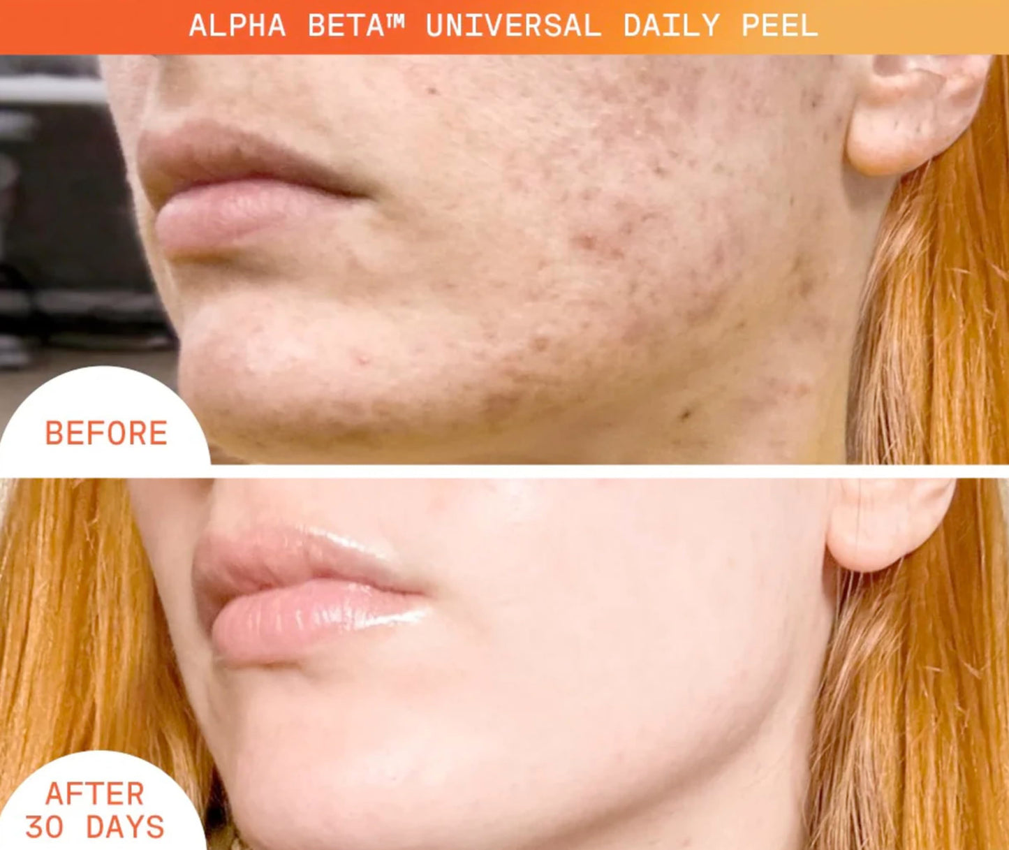 Dr. Dennis Gross Alpha Beta Universal Daily Peel: for Uneven Tone or Texture and Fine Lines or Enlarged Pores, (5 Treatments)