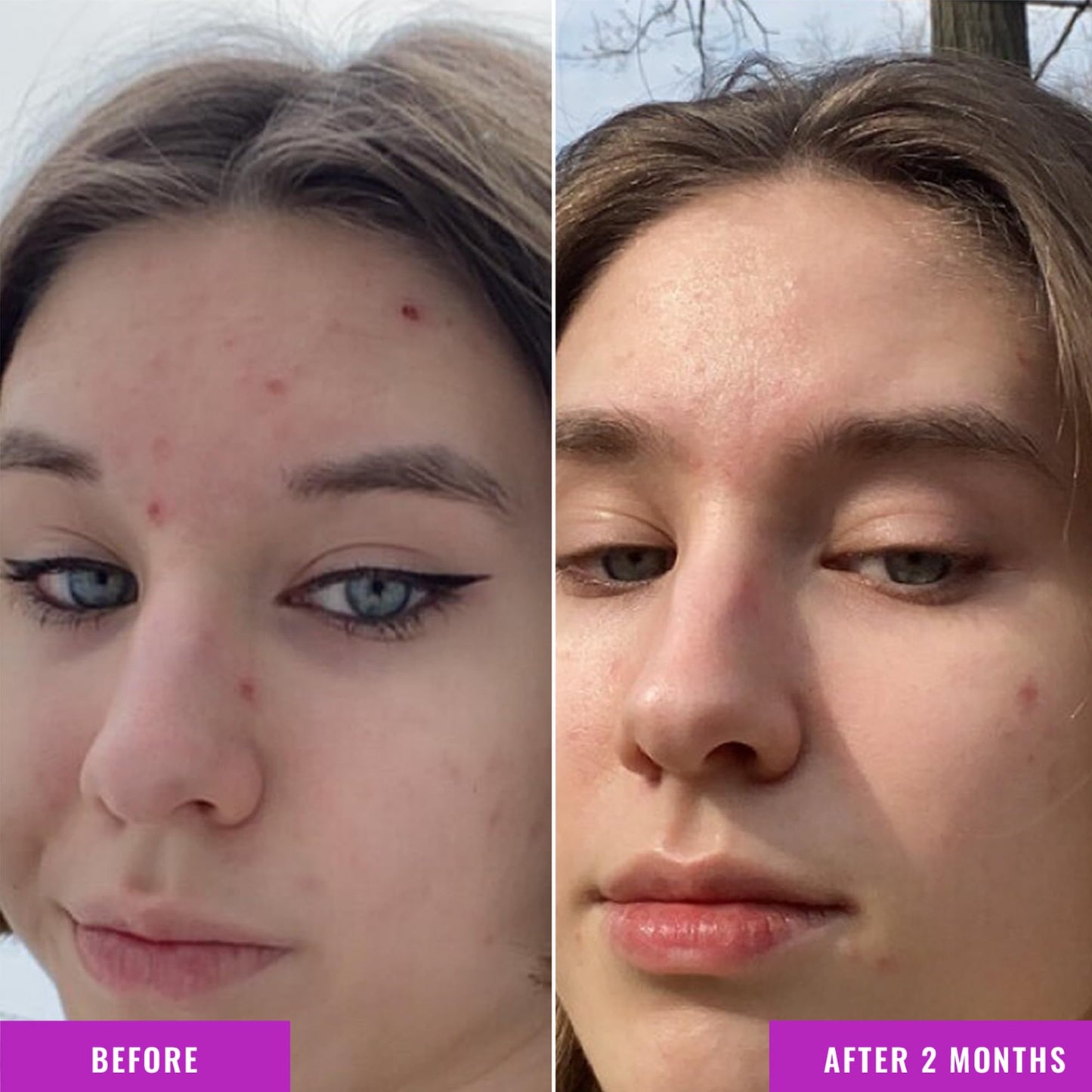 Good Molecules Niacinamide Serum 10% – Targets Acne, Brightens & Hydrates Skin, Improves Tone – Face Skincare Treatment