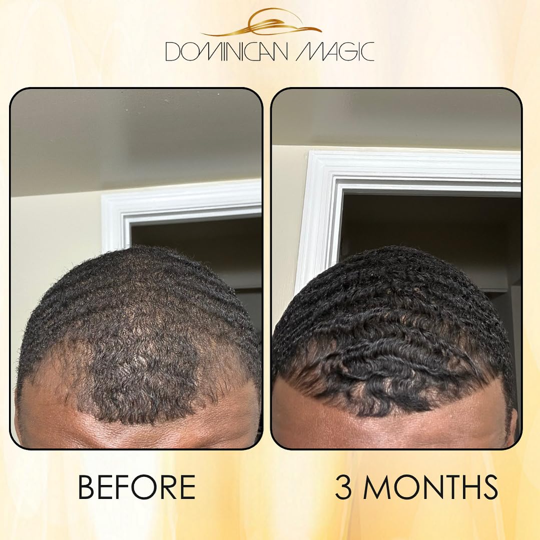 Dominican Magic Hair Follicle Anti-Aging Scalp Drop Hair Tonic with Rosemary and Cinnamon, Gotero Anti-Caida, Helps Stimulate Hair Growth, 2.01 Oz