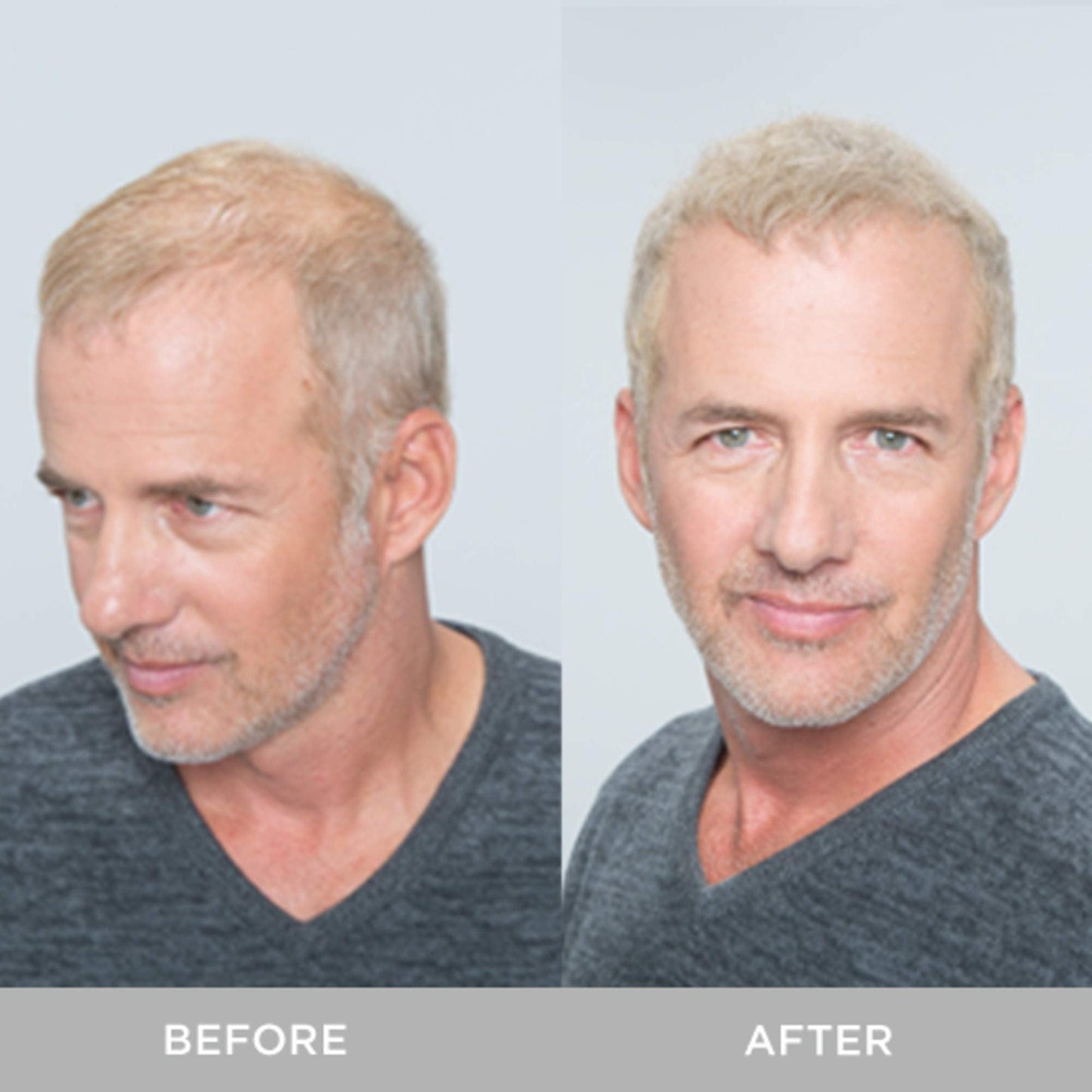 XFusion Keratin Hair Fibers - Dark Brown (Large Size 28g)