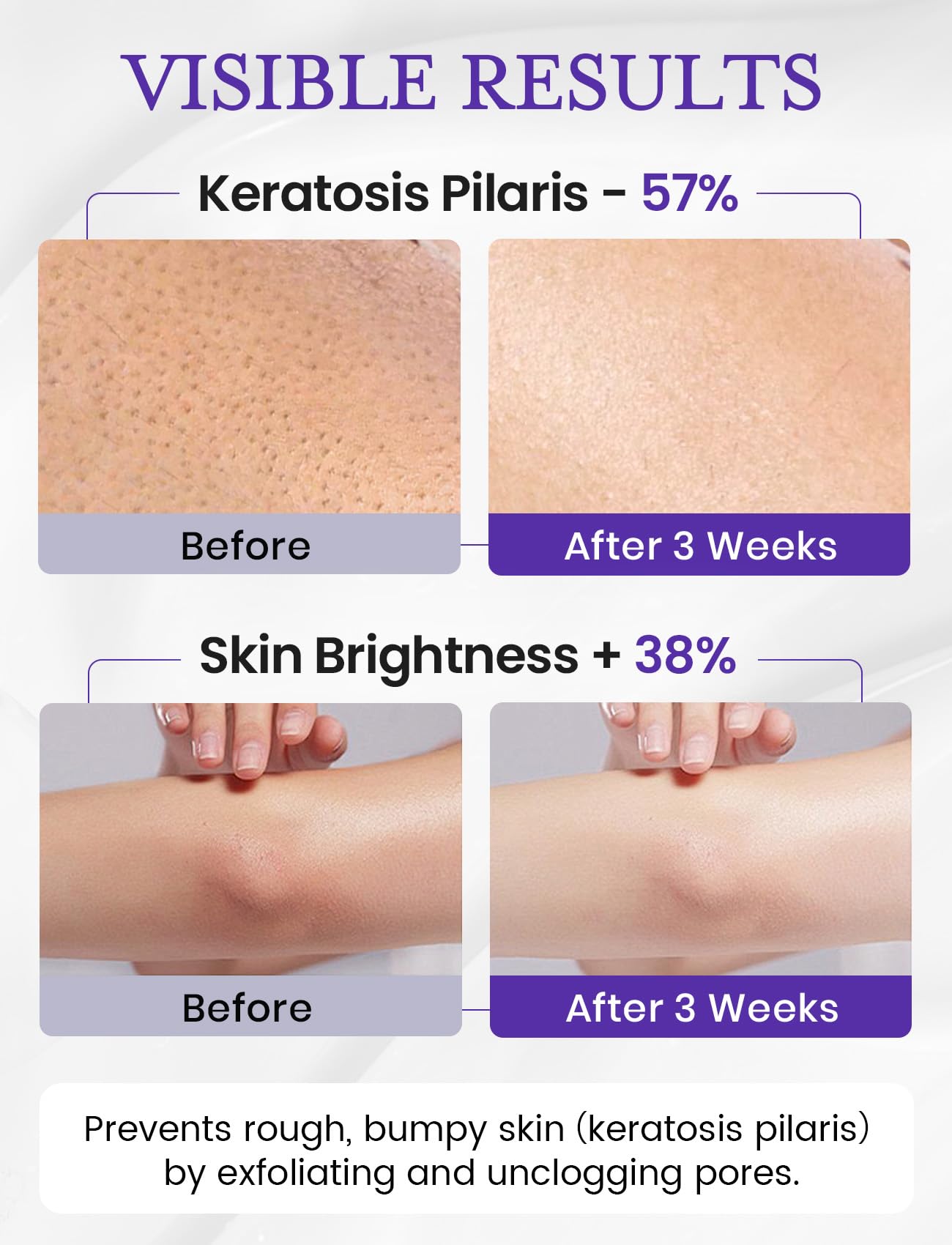 Elvira KP Bump Eraser Scrub – Exfoliating Foot & Body Cleanser with 10% AHA/BHA & Niacinamide for Smooth, Moisturized Skin