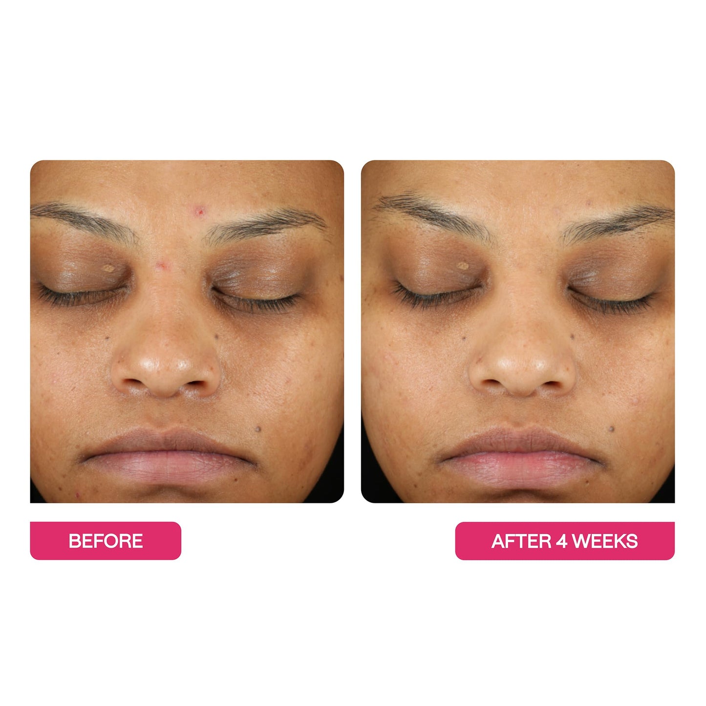 BeautyStat Triple Action Daily Exfoliating Peel Pads – Brighten, Smooth, Minimize Pores with AHAs, BHAs & Glucosamine, Made in USA