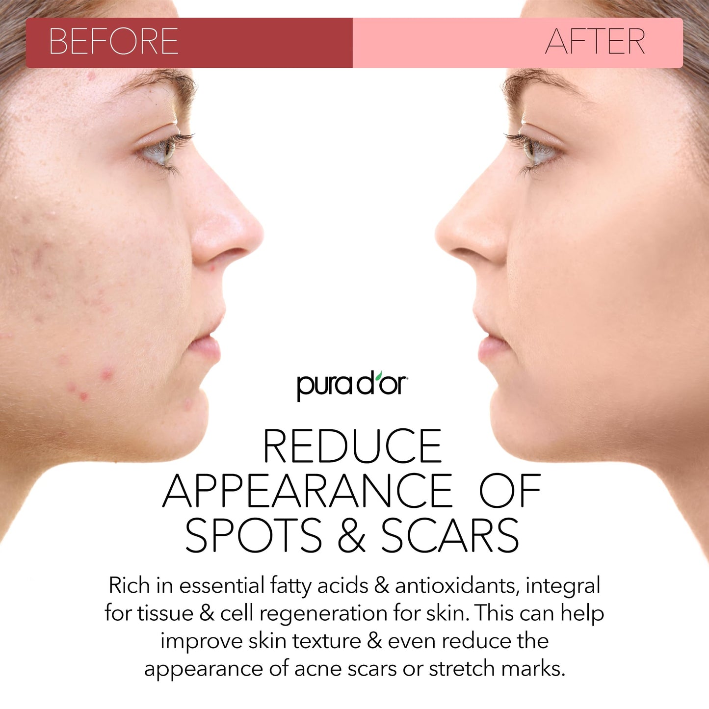 PURA D'OR Organic Rosehip Seed Oil 4oz – 100% Pure Cold Pressed USDA Certified – Anti-Aging, Scar & Stretch Mark Treatment for Face, Hair & Body