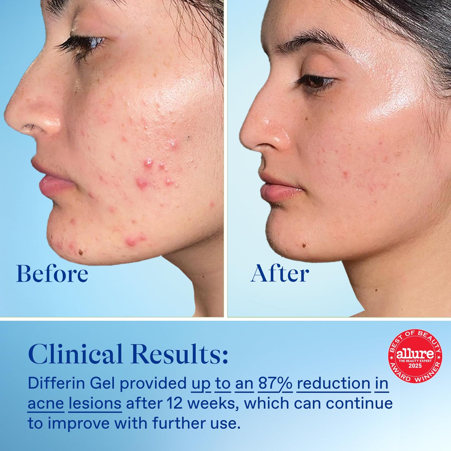 Differin Adapalene 0.1% Acne Treatment Gel – 30-Day Supply, Gentle Retinoid for Sensitive, Acne-Prone Skin, 15g Pump