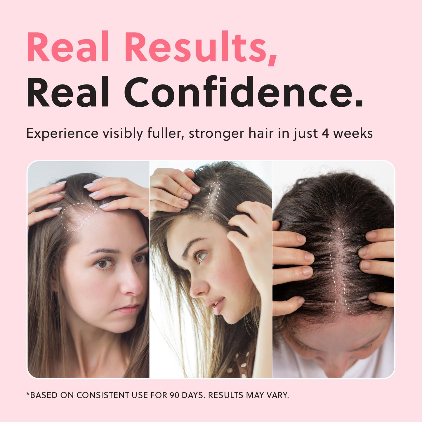 Forhair Hair Regrowth Serum - Strengthens, Thickens & Accelerates Growth - Fights Hair Thinning & Loss, Non-Greasy, Hormone-Free Scalp Spray, 50ml