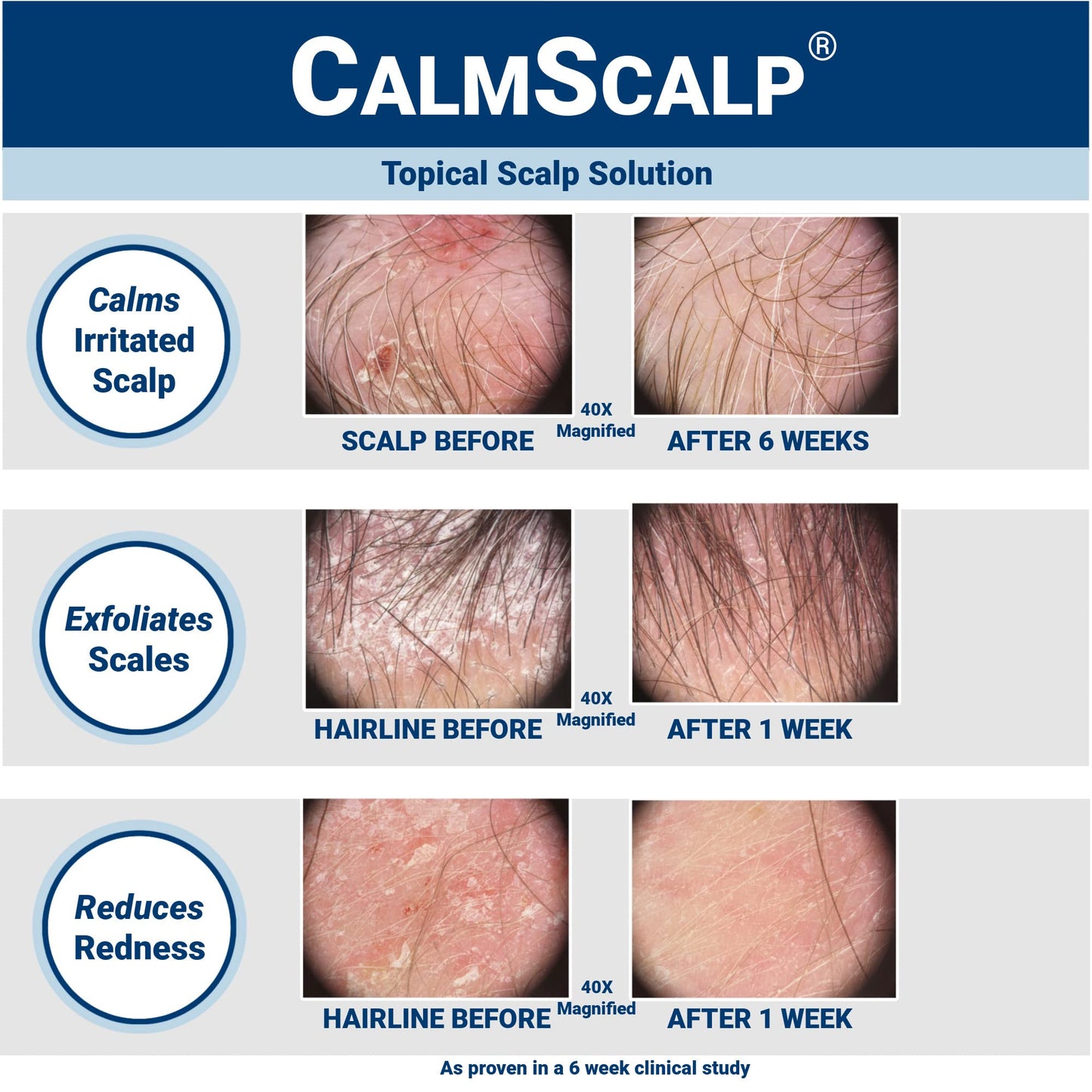 CalmScalp Scalp Serum | Scalp Itch Relief | Scalp Treatment | Exfoliates Scales and Flakes | Clinically Proven | Made in USA | 4 oz