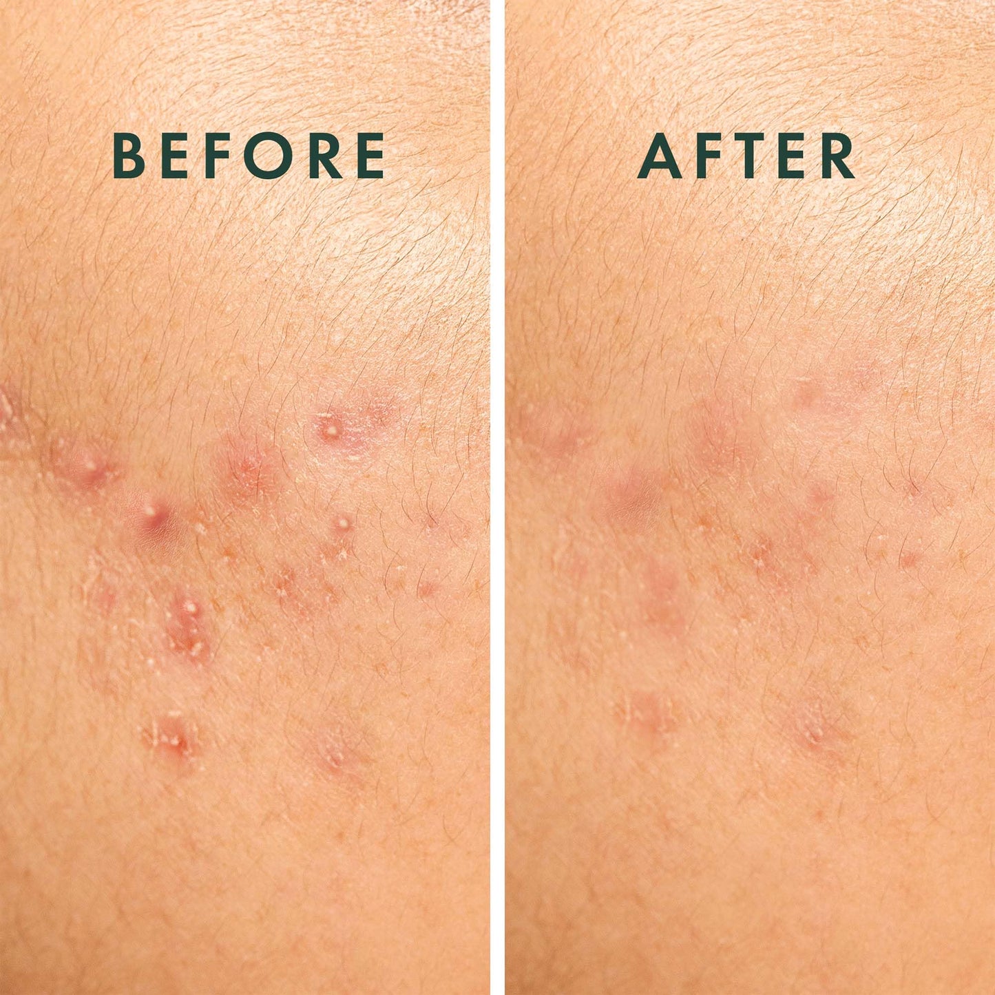 Rael Pimple Patches – Hydrocolloid Spot Control for Acne, Zits & Blemishes, Korean Skincare, Vegan & Cruelty-Free, 20 Count