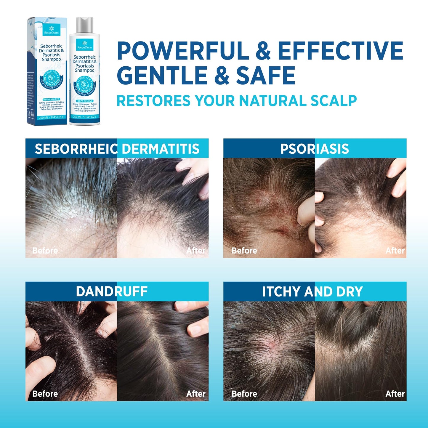 Seborrheic Dermatitis & Psoriasis Scalp Care Set – Therapeutic Shampoo, Conditioner & Cream for Itchy, Flaky, Dry Scalp Relief