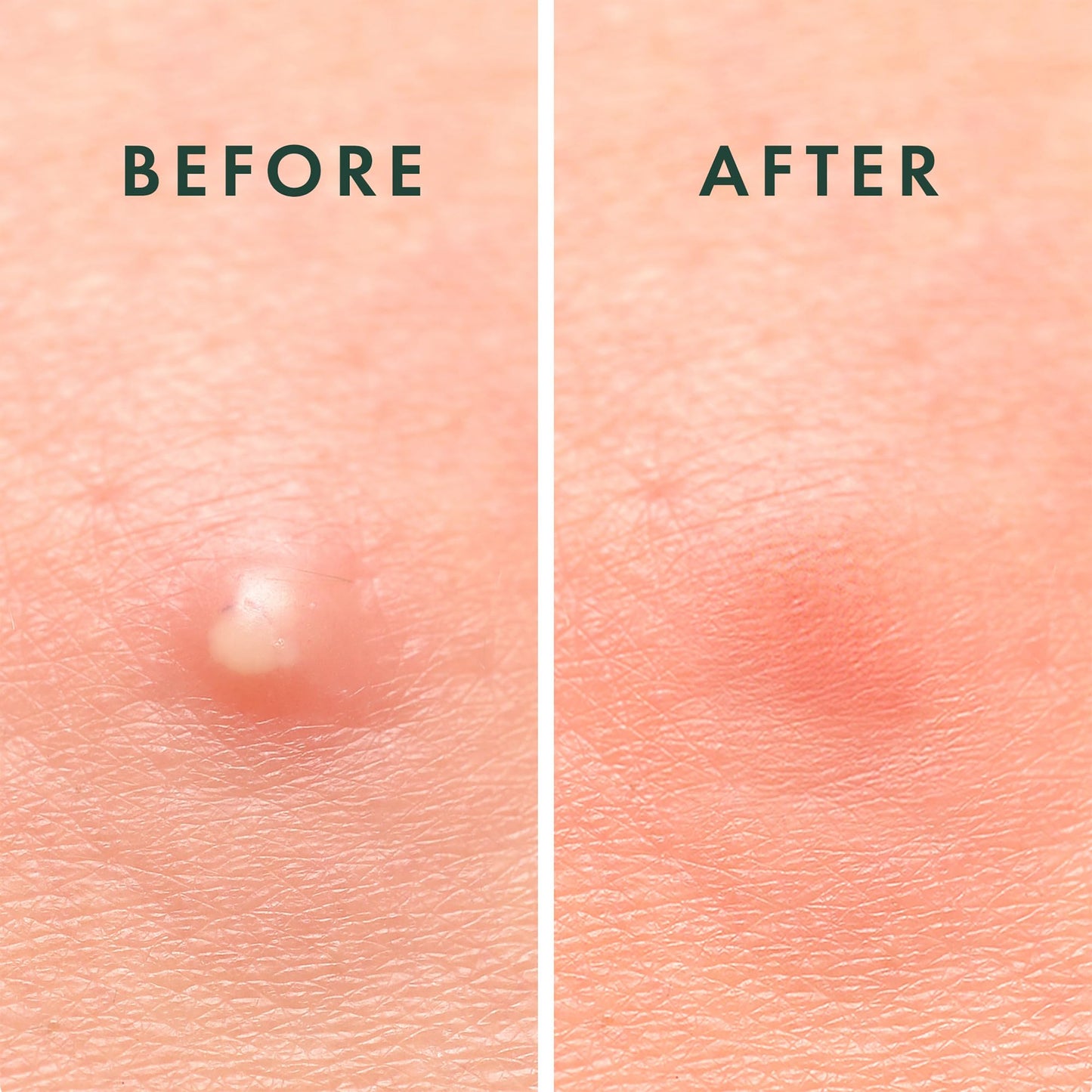 Rael Miracle Invisible Pimple Patches - Hydrocolloid Acne Spot Cover for Breakouts, Absorbs Zits & Blemishes, Korean Skincare, 2 Sizes, 96 Ct