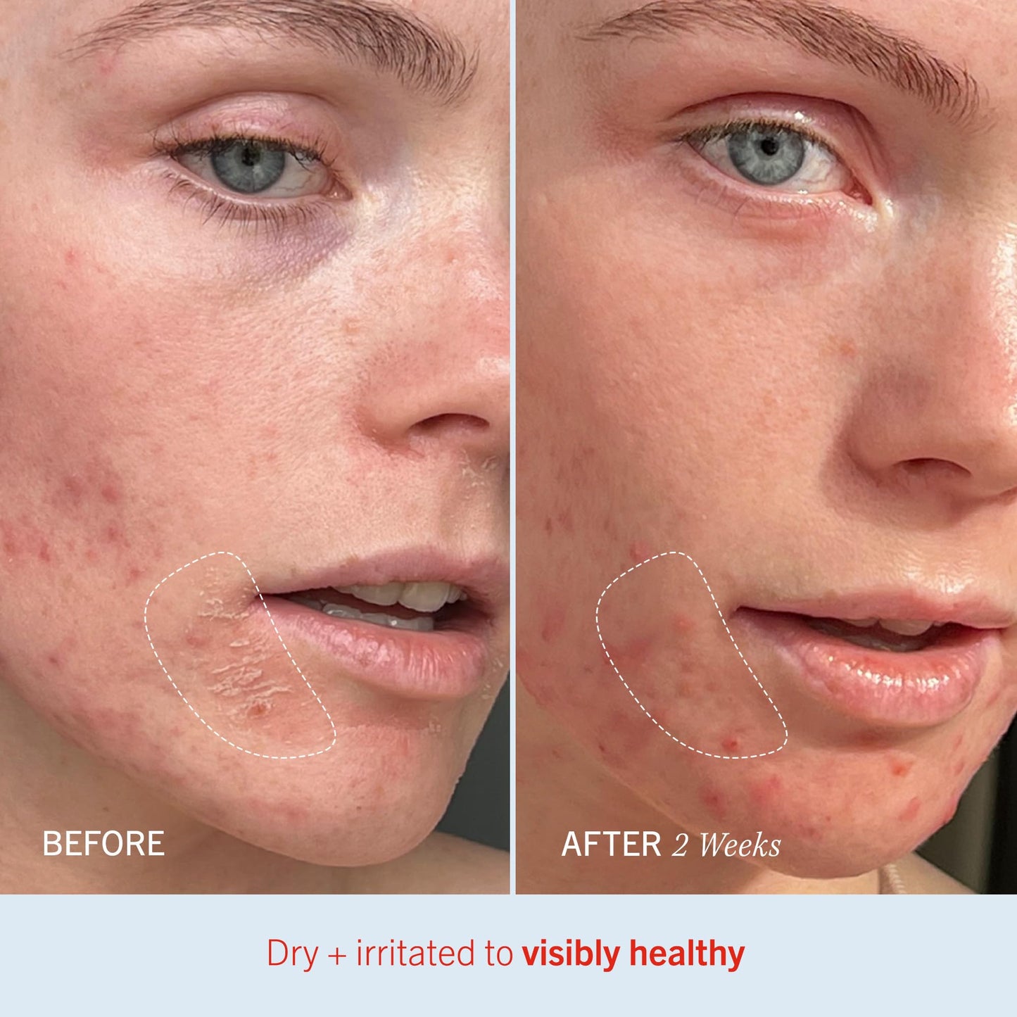 First Aid Beauty Ultra Repair Cream - 6oz Whipped Moisturizer with Colloidal Oatmeal, Clinically Proven Hydration & Skin Barrier Relief for Eczema