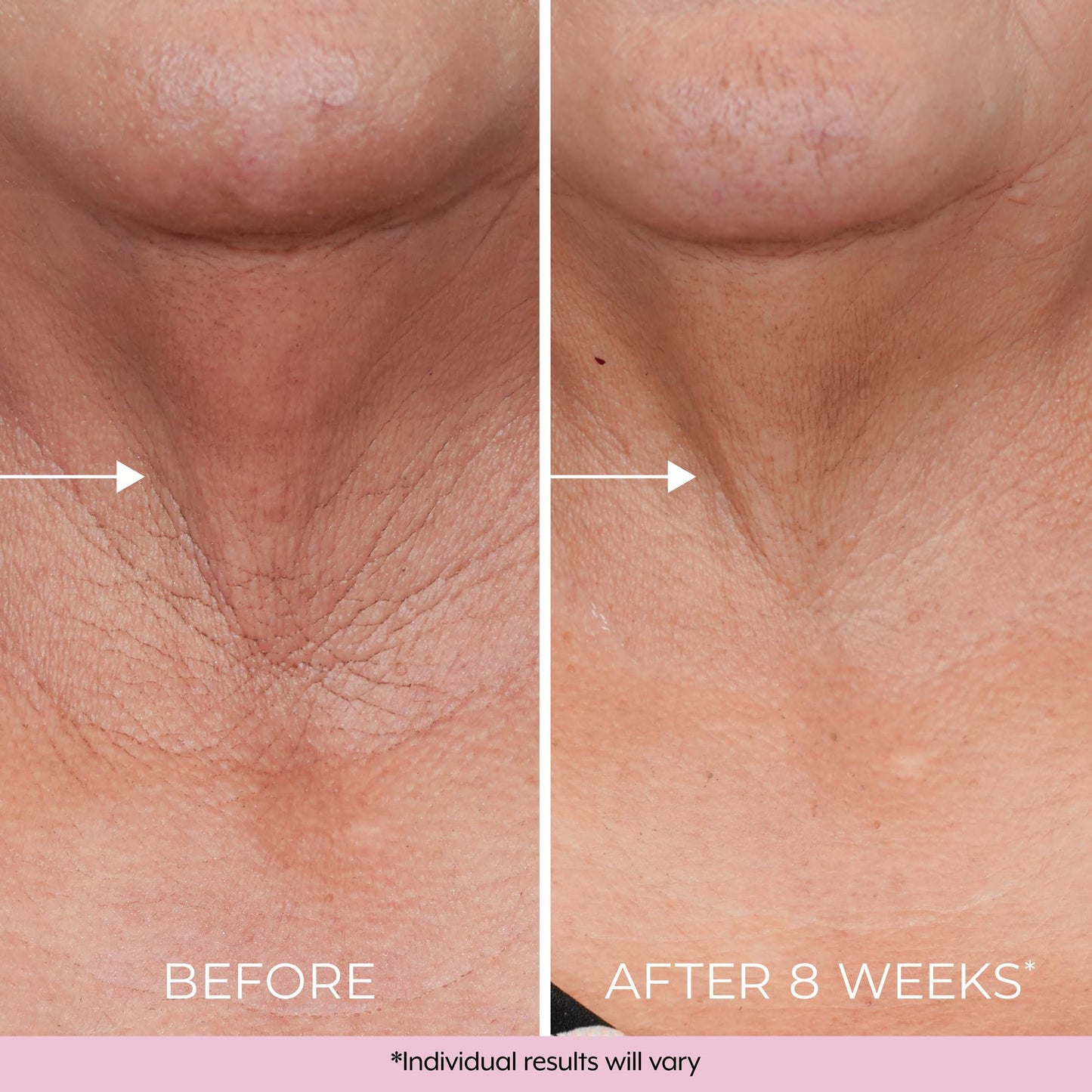 DEKLIDERM Neck Firming Cream – Anti Aging Retinol Cream Visibly Reduces Neck Wrinkles and Sagging – Neck Cream for loss of Firmness