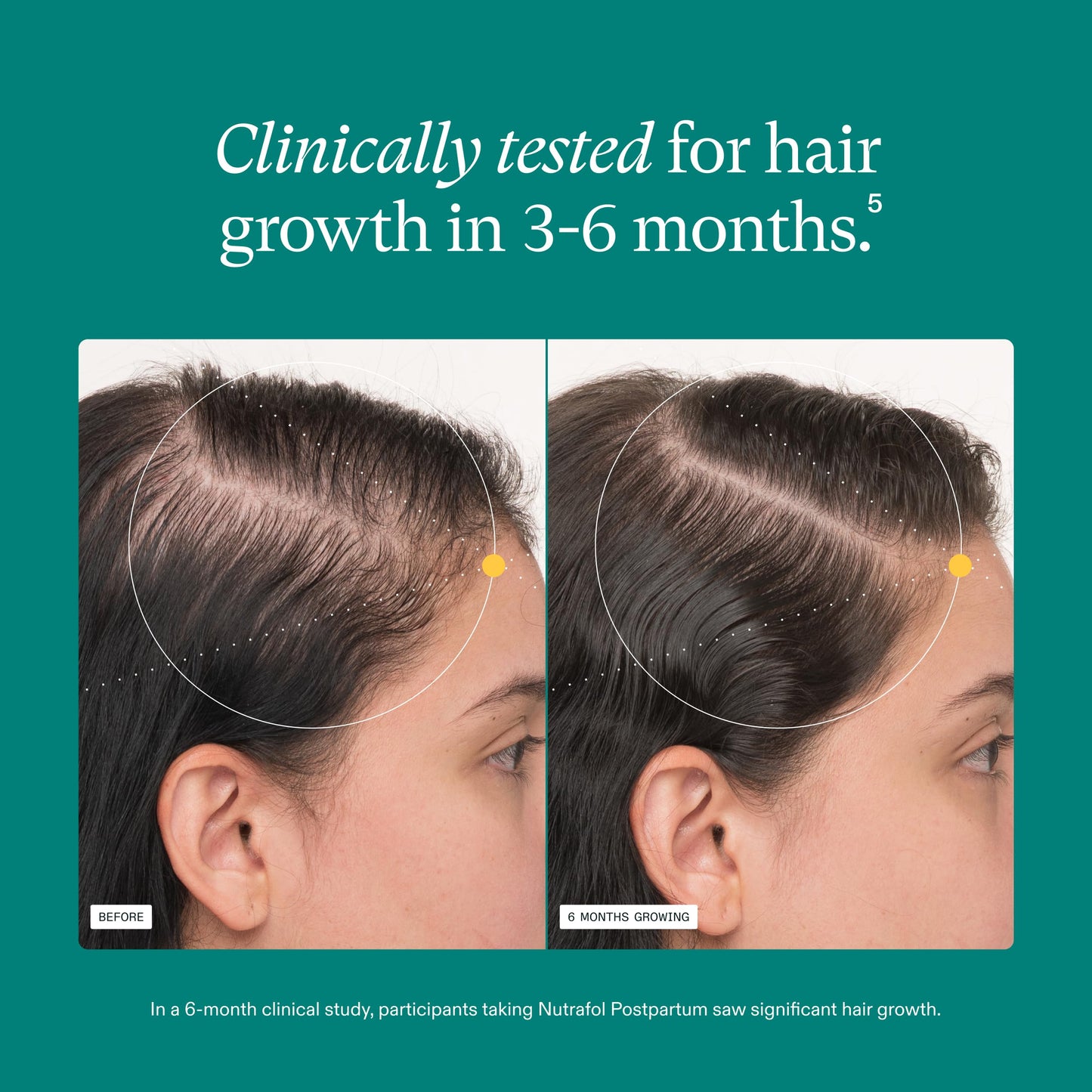 Nutrafol Postpartum Hair Growth Supplements, Clinically Tested for Visibly Thicker Hair and Less Shedding, Breastfeeding-friendly - 1 Month Supply