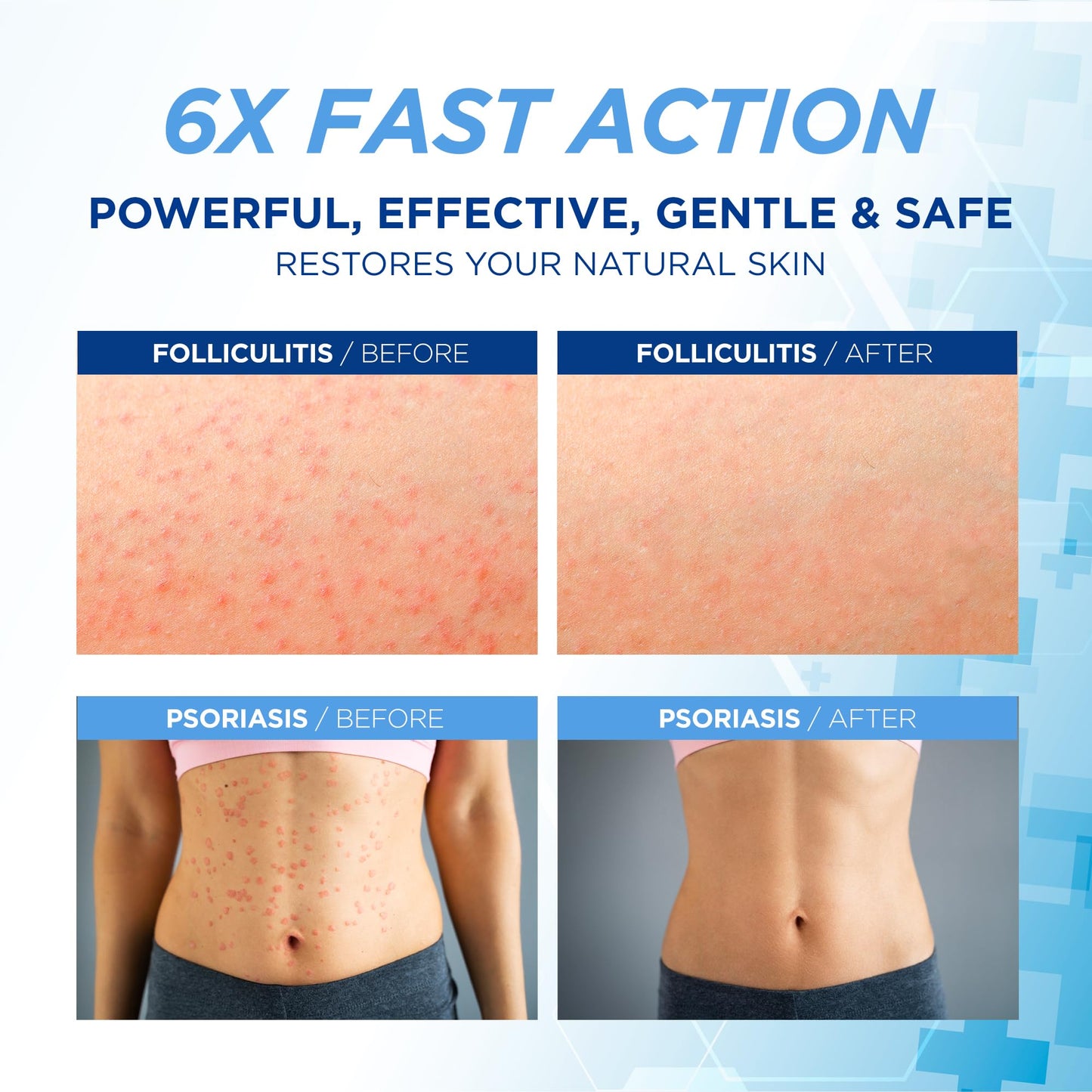 Folliculitis Treatment Cream: Effective Treatment for Folliculitis Scalp Face and Body 100g