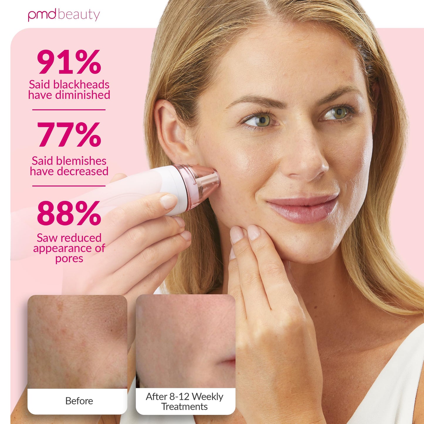 PMD Personal Microderm Pro - At-Home Microdermabrasion Machine with Kit for Face & Body -5 Piece set(Pack of 1), Blush