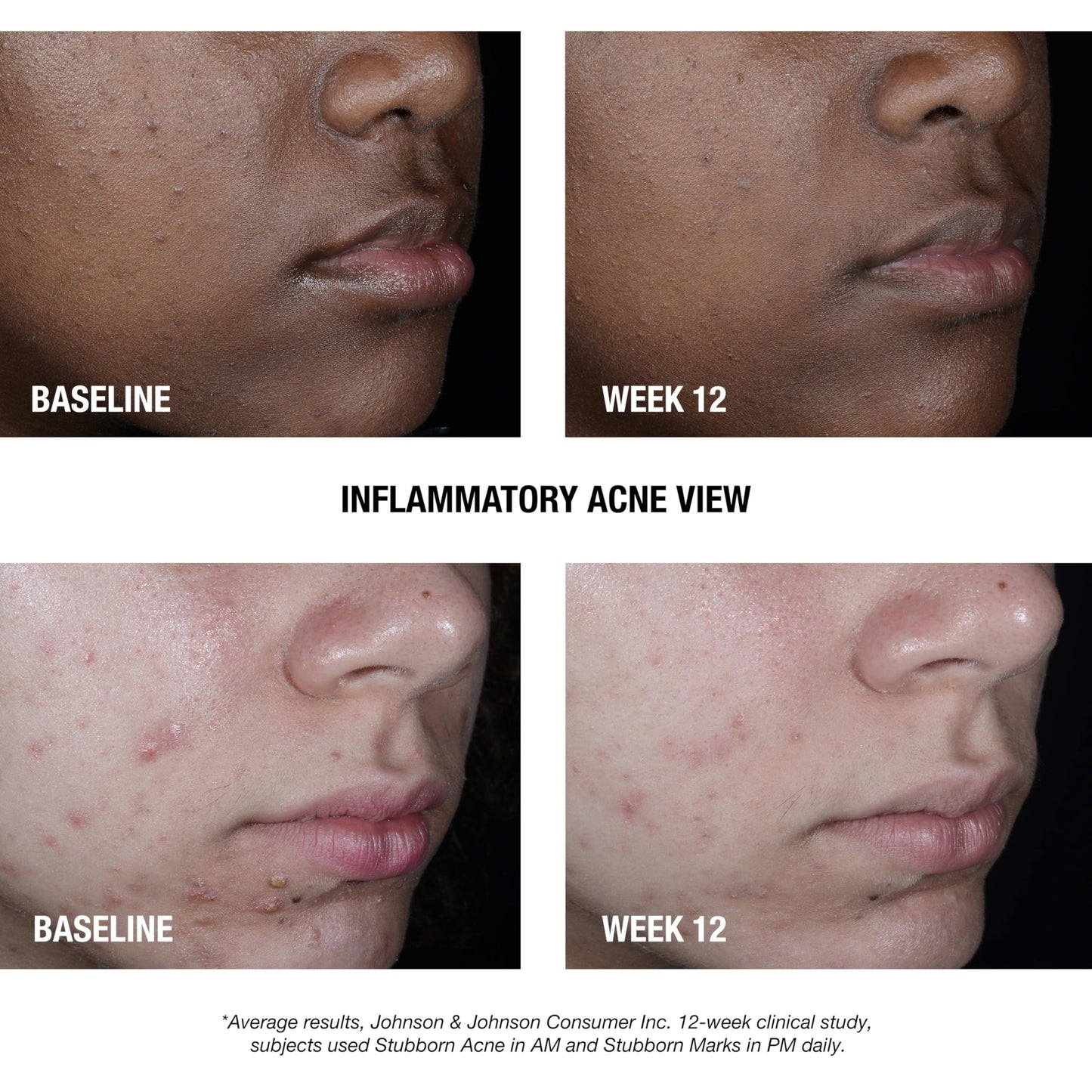 Neutrogena Stubborn Acne AM Treatment - 2.5% Benzoyl Peroxide, Oil-Free, Reduces Breakout Size & Redness, Paraben-Free, 2 oz